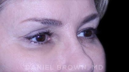 Blepharoplasty Before & After Patient #8730