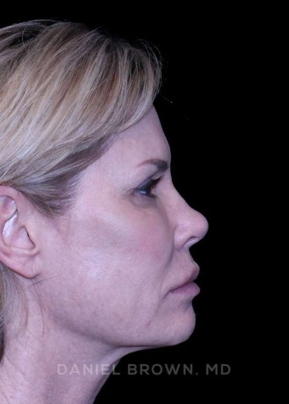Blepharoplasty Before & After Patient #8730