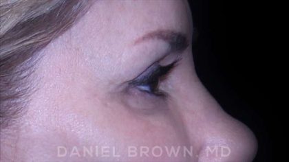 Blepharoplasty Before & After Patient #8730