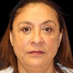 Blepharoplasty Before & After Patient #8751