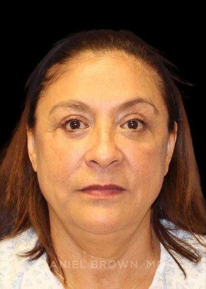 Blepharoplasty Before & After Patient #8751