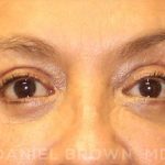 Blepharoplasty Before & After Patient #8751