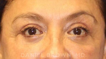 Blepharoplasty Before & After Patient #8751