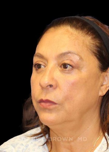 Blepharoplasty Before & After Patient #8751