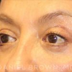 Blepharoplasty Before & After Patient #8751