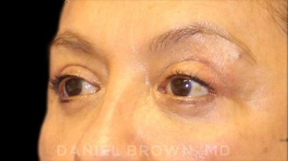 Blepharoplasty Before & After Patient #8751