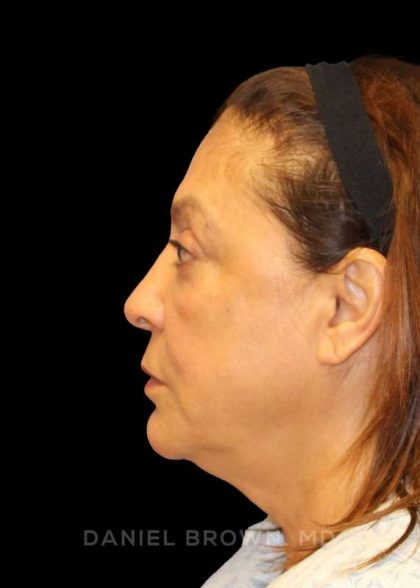 Blepharoplasty Before & After Patient #8751