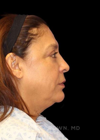 Blepharoplasty Before & After Patient #8751