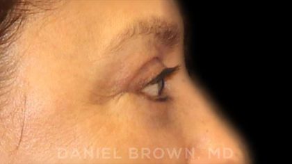 Blepharoplasty Before & After Patient #8751