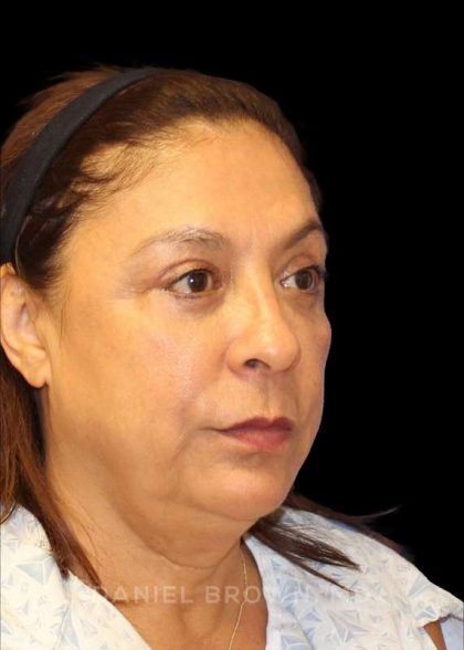 Blepharoplasty Before & After Patient #8751