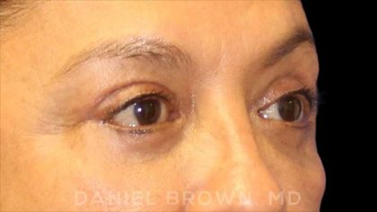 Blepharoplasty Before & After Patient #8751