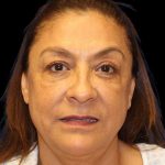 Blepharoplasty Before & After Patient #8751