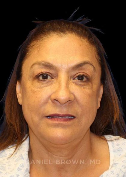 Blepharoplasty Before & After Patient #8751