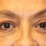 Blepharoplasty Before & After Patient #8751