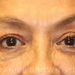 Blepharoplasty Before & After Patient #8751