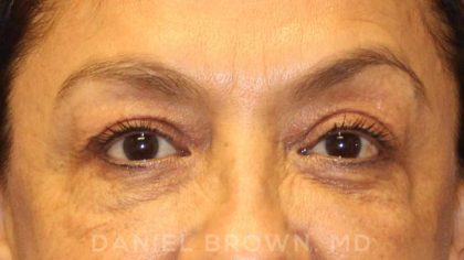 Blepharoplasty Before & After Patient #8751
