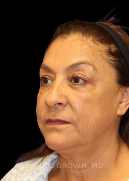 Blepharoplasty Before & After Patient #8751
