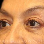 Blepharoplasty Before & After Patient #8751