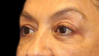 Blepharoplasty Before & After Patient #8751