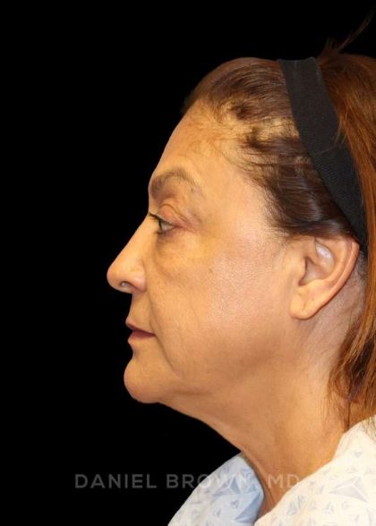 Blepharoplasty Before & After Patient #8751