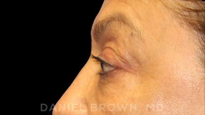 Blepharoplasty Before & After Patient #8751
