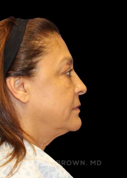 Blepharoplasty Before & After Patient #8751