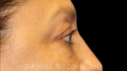 Blepharoplasty Before & After Patient #8751