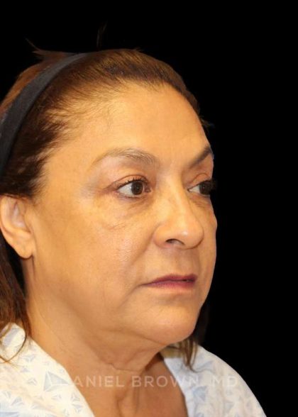Blepharoplasty Before & After Patient #8751