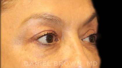 Blepharoplasty Before & After Patient #8751