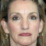 Blepharoplasty Before & After Patient #8766