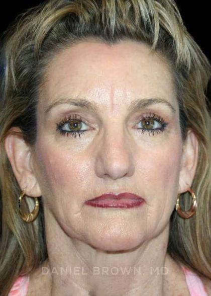 Blepharoplasty Before & After Patient #8766