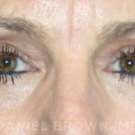 Blepharoplasty Before & After Patient #8766