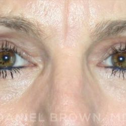 Blepharoplasty Before & After Patient #8766