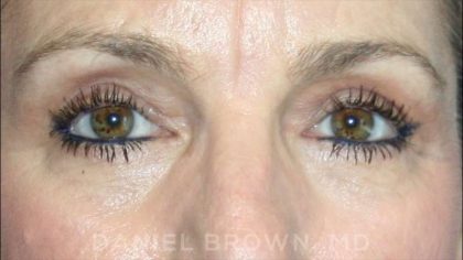 Blepharoplasty Before & After Patient #8766