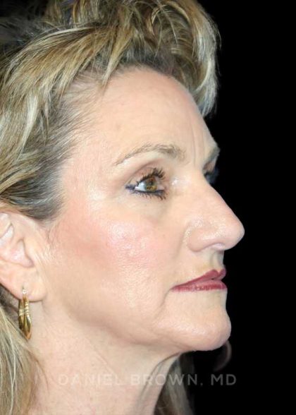 Blepharoplasty Before & After Patient #8766
