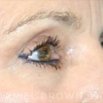 Blepharoplasty Before & After Patient #8766