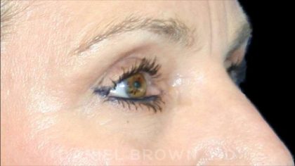 Blepharoplasty Before & After Patient #8766