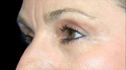 Blepharoplasty Before & After Patient #8766