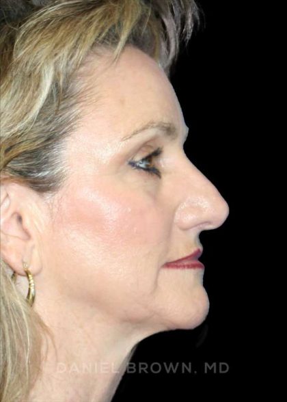 Blepharoplasty Before & After Patient #8766