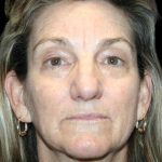 Blepharoplasty Before & After Patient #8766