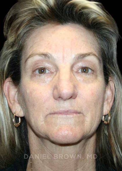 Blepharoplasty Before & After Patient #8766