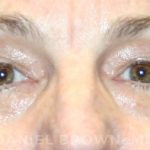 Blepharoplasty Before & After Patient #8766