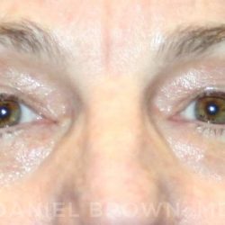 Blepharoplasty Before & After Patient #8766