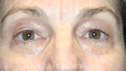 Blepharoplasty Before & After Patient #8766