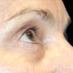 Blepharoplasty Before & After Patient #8766