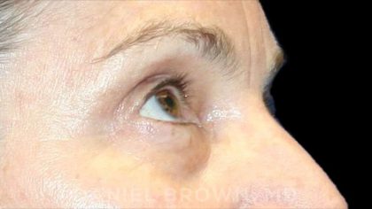 Blepharoplasty Before & After Patient #8766