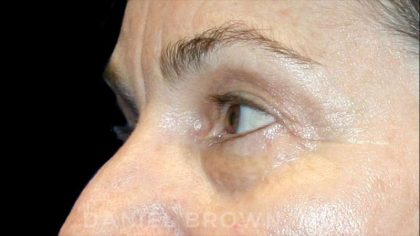 Blepharoplasty Before & After Patient #8766