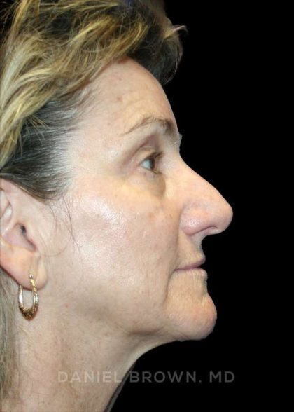 Blepharoplasty Before & After Patient #8766