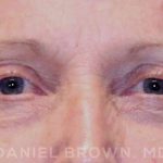 Blepharoplasty Before & After Patient #8787