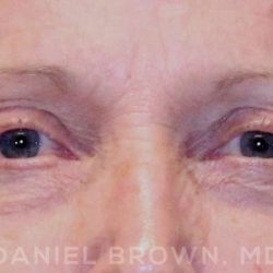 Blepharoplasty Before & After Patient #8787